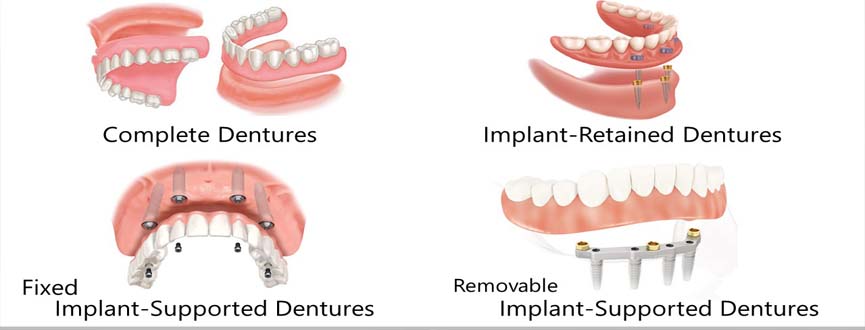 All types of Denture in Ahmedabad