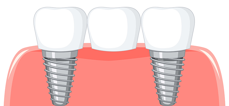 Bridge or Implant in Ahmedabad