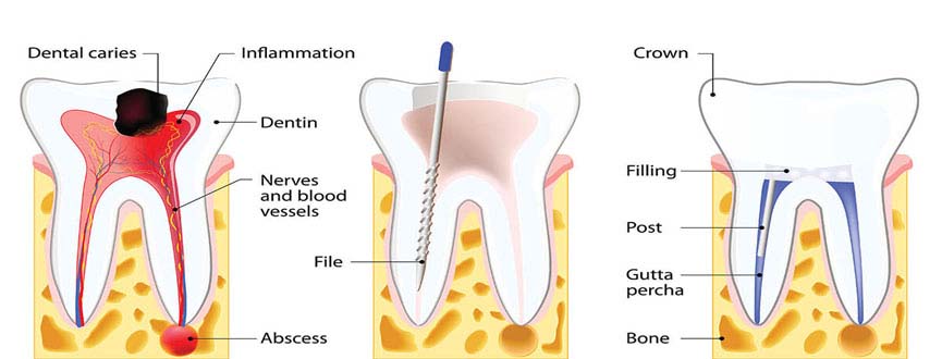 Root Canal Treatment in Ahmedabad