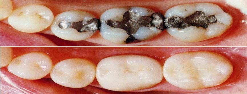 Tooth Filling in Ahmedabad